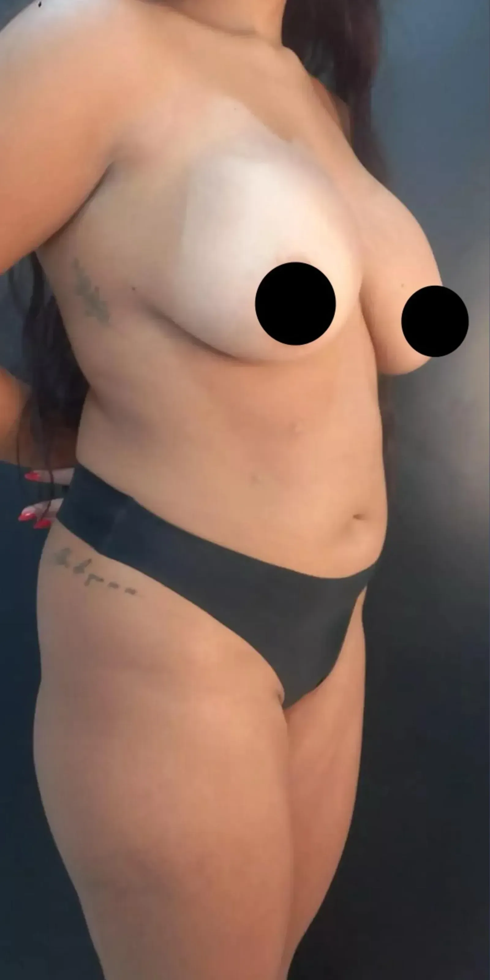 Antes da cirurgia plástica corporal