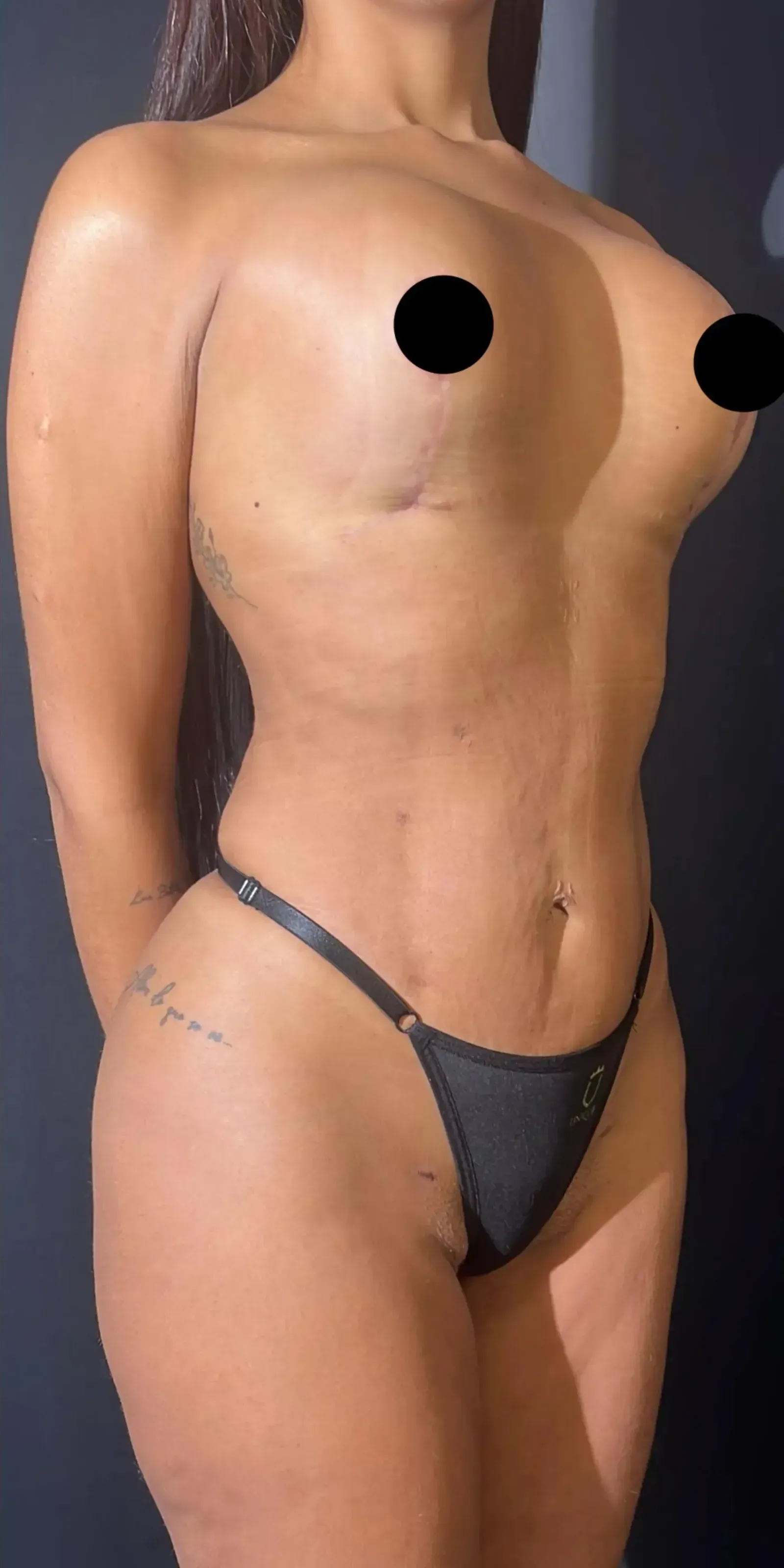 Depois da cirurgia plástica corporal