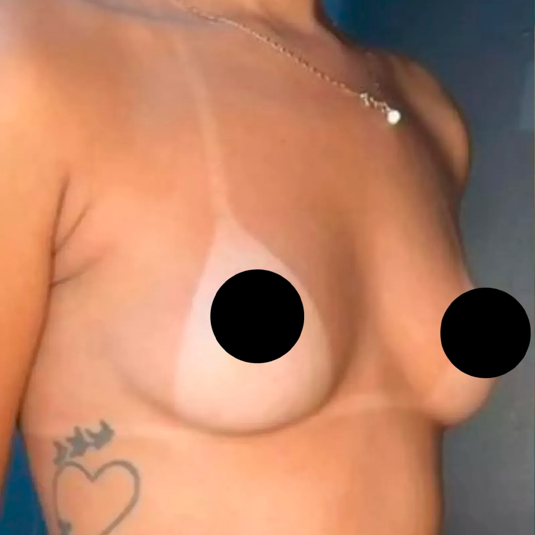 Antes da cirurgia plástica mamária