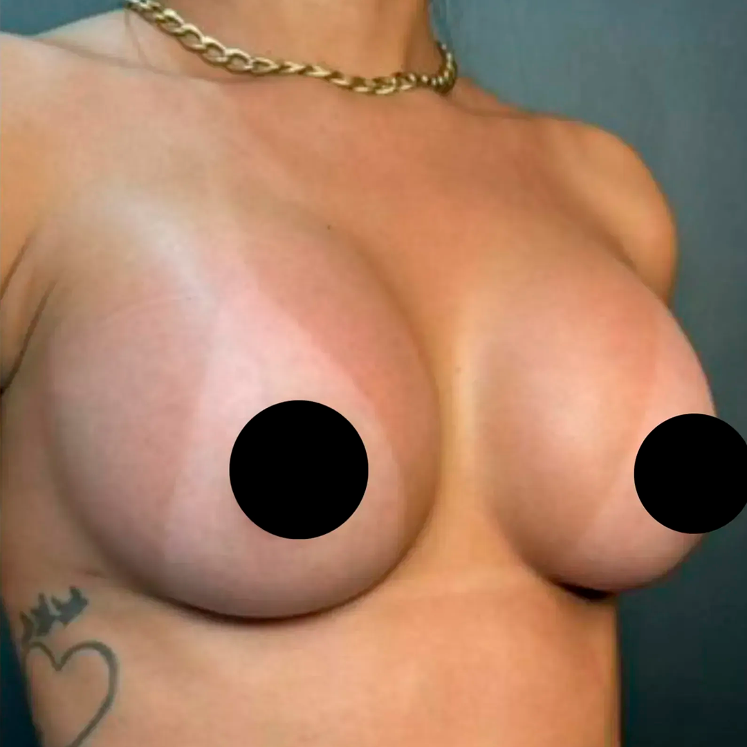 Depois da cirurgia plástica mamária